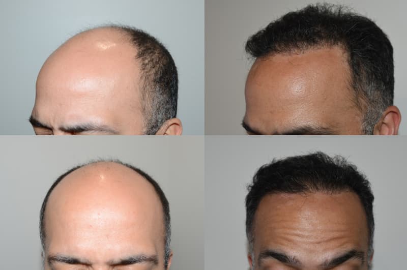 Before and after hair transplant