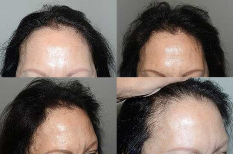 Before and after hair transplant