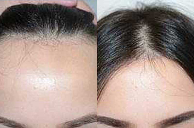 Before and after hairline lowering / forehead reduction