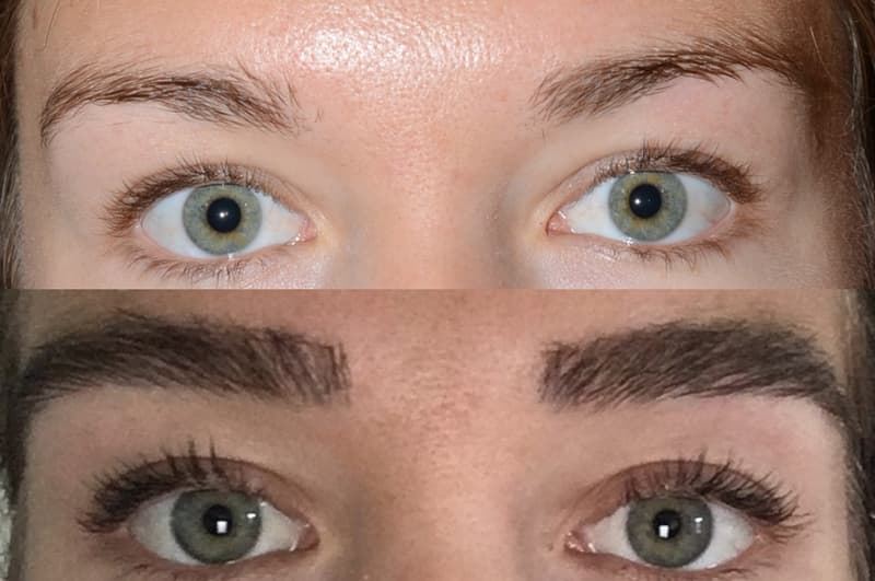 Before and after eyebrow transplant