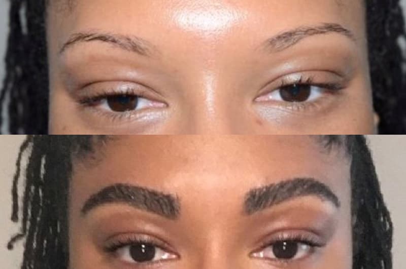 Before and after eyebrow transplant