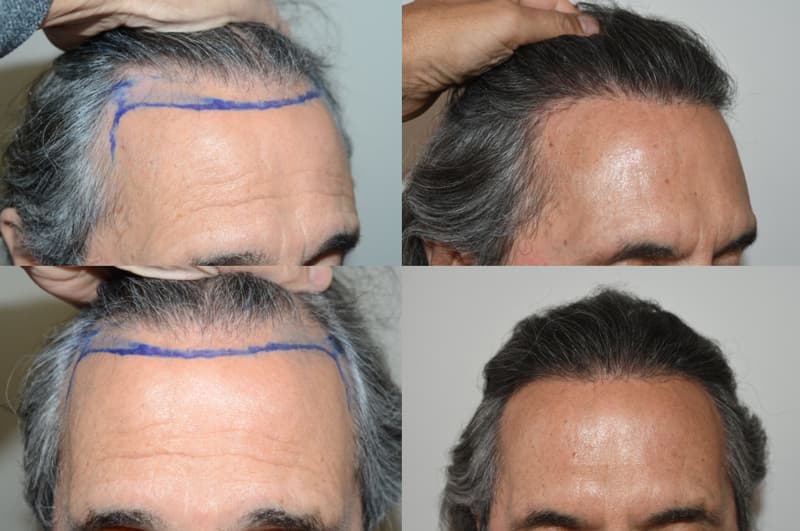 Before and after hairline lowering / forehead reduction