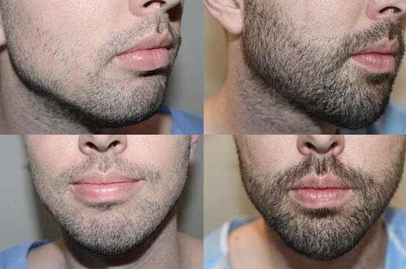Before and after beard transplant