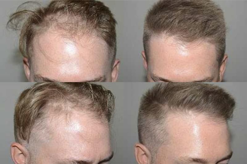 Before and after hair transplant