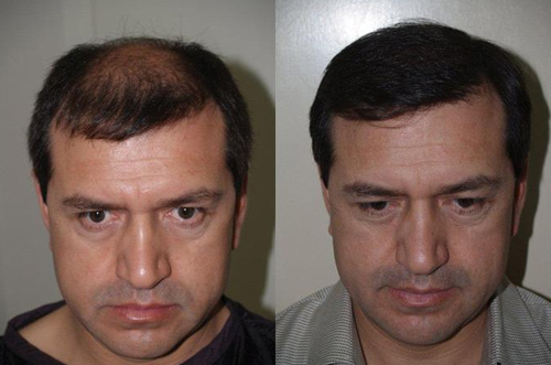 Before-and-after photos showing improved hair density with a straight-on view.