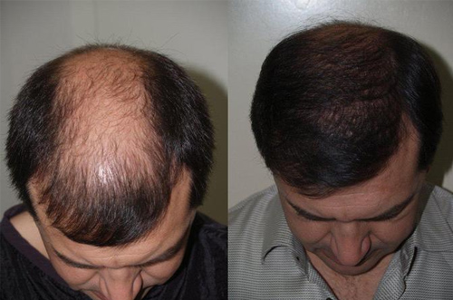 Before-and-after photos showing improved hair density from the top of the scalp.