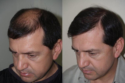 Before-and-after photos showing improved hair density from the front.
