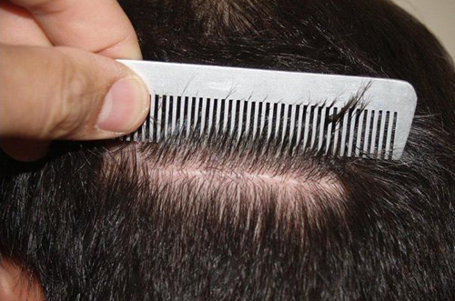 Comb parting a person's hair to show the scalp.