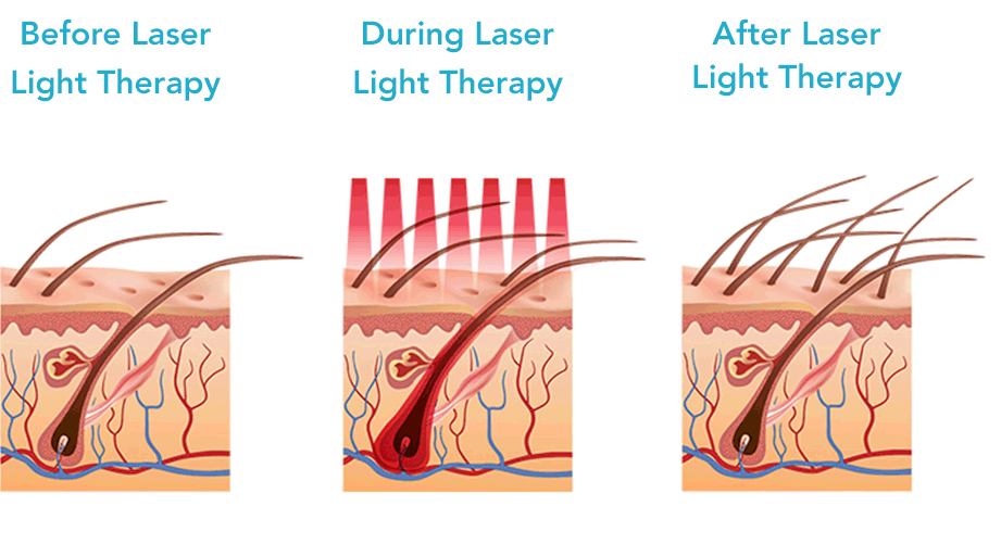 Illustration showing hair follicles before, during, and after laser light therapy with increased hair growth over time.