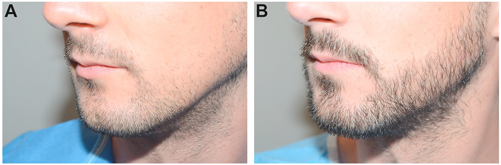 Facial Hair in Hair Restoration Surgery