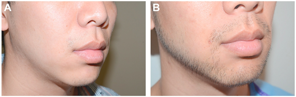 Facial Hair in Hair Restoration Surgery