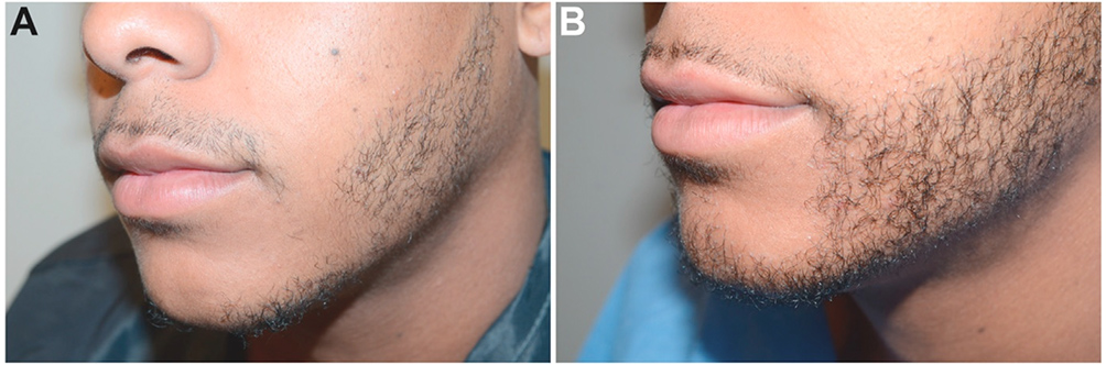 Facial Hair in Hair Restoration Surgery