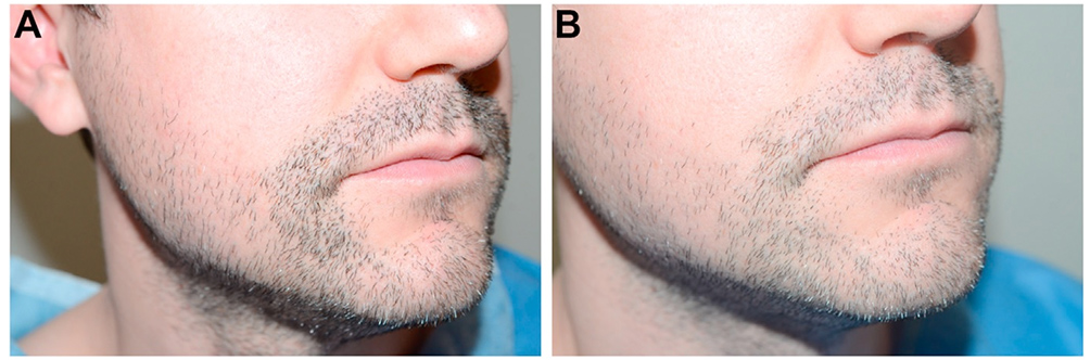 Facial Hair in Hair Restoration Surgery