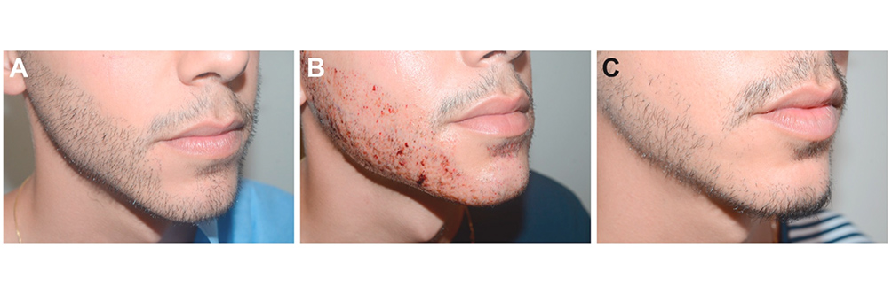 Facial Hair in Hair Restoration Surgery