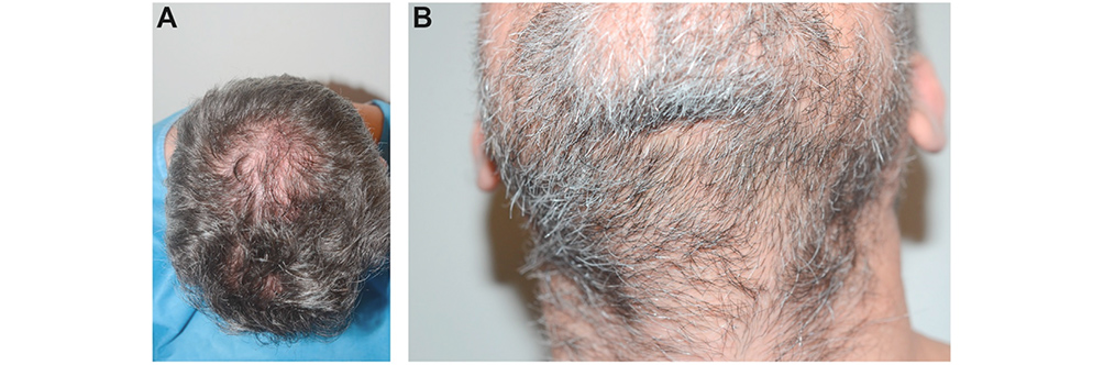 Facial Hair in Hair Restoration Surgery