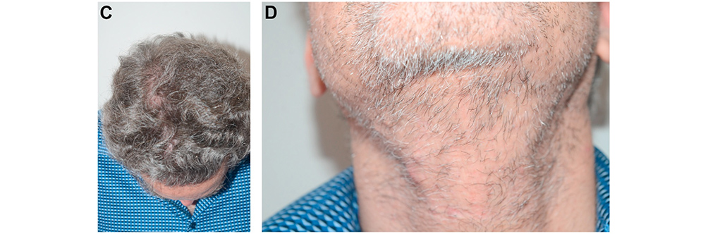 Facial Hair in Hair Restoration Surgery