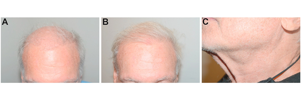 Facial Hair in Hair Restoration Surgery