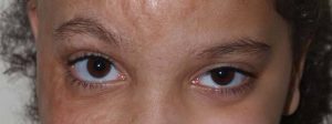 Close-up of a young patient's healing eyebrow incision during the early stages of recovery.