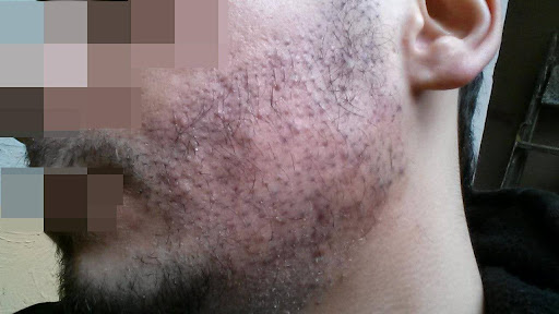 Close-up of a man's cheek showing patchy beard growth following a beard transplant.