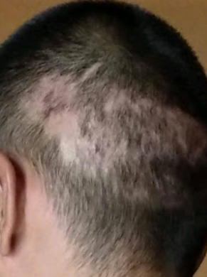 Close-up of the back of a shaved head showing scarring and uneven hair growth.