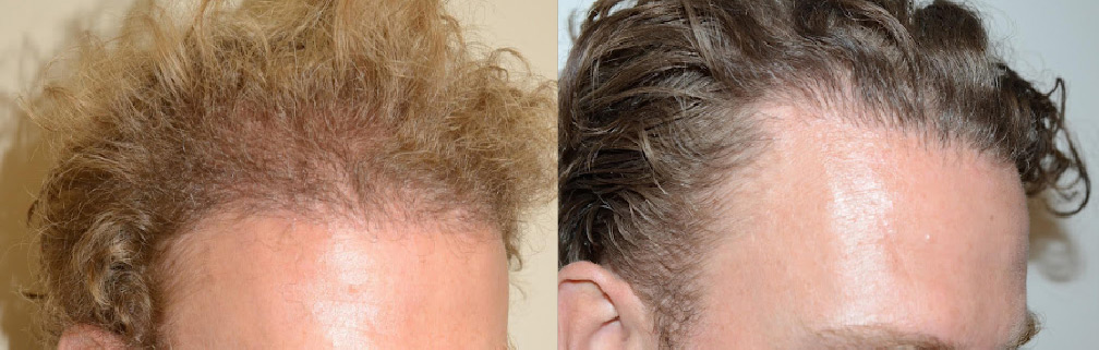Before and after photos showing improved hair density and hairline following hair transplant surgery.