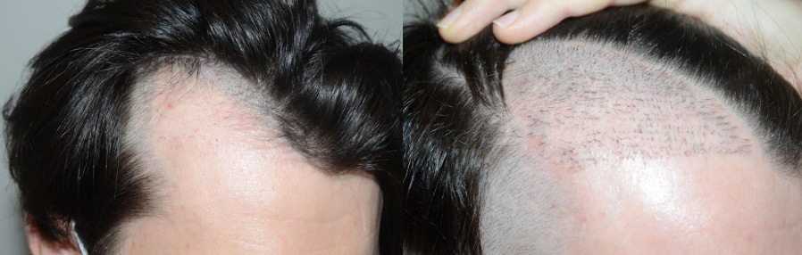 Before and after photos showing hairline restoration before and immediately after a hair transplant procedure.