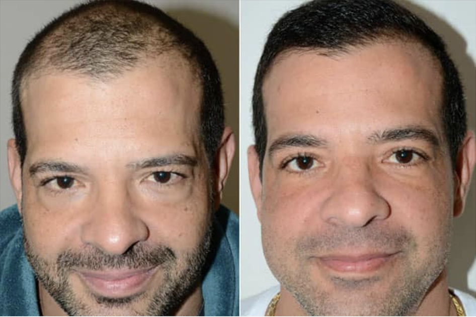 BEFORE AND AFTER 1,750 FUE GRAFTS