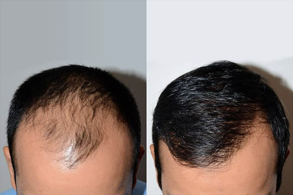Before and After 2,050 FUE Grafts