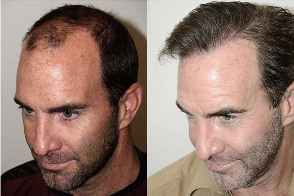 Before and After 3,200 FUE Grafts