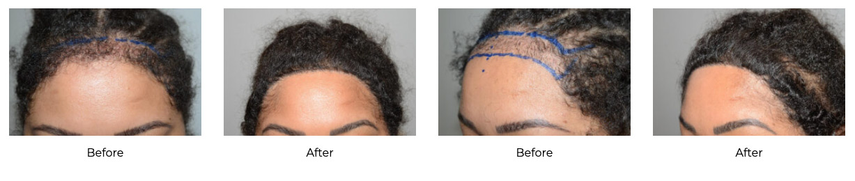 Before and after photos showing restored hairlines in patients with traction alopecia.
