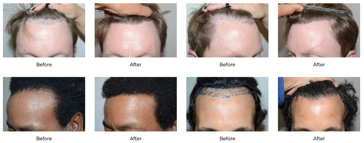 Before and after photos showing hairline restoration results in multiple hair transplant patients.