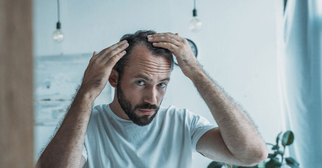 Male Pattern Baldness: Causes, Stages, and the Best Treatment for Each Stage Guide