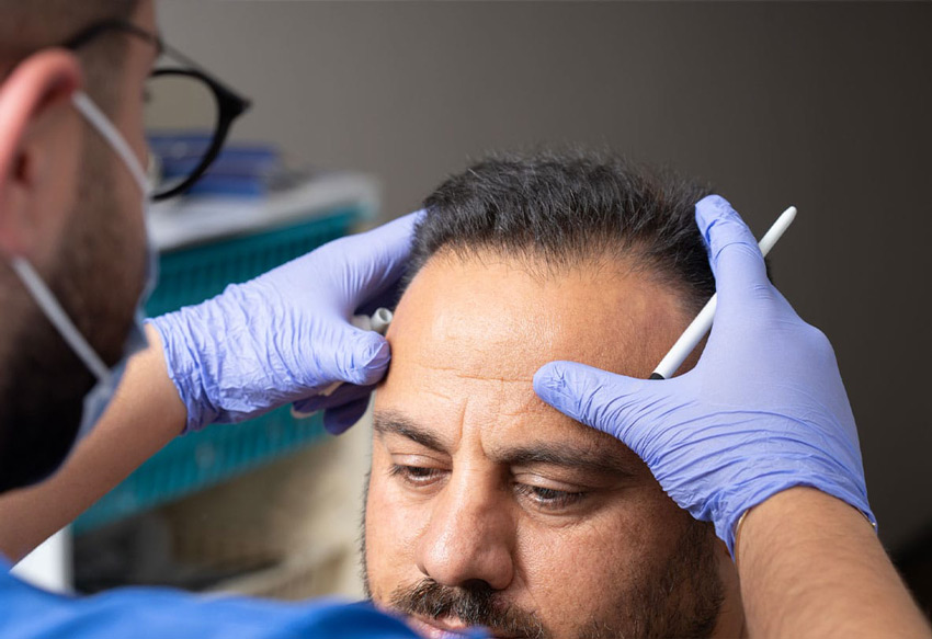 Male Pattern Baldness: Causes, Stages, and the Best Treatment for Each Stage Guide