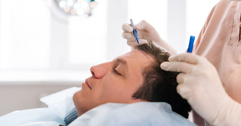 Donor Depletion: The One Complication From Hair Restoration Surgery in Turkey That Is Permanent