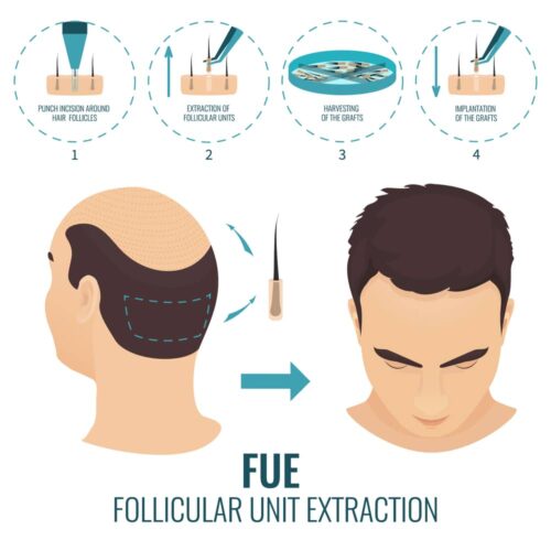 Illustration showing the steps of the FUE (Follicular Unit Extraction) hair transplant procedure.