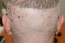 Back of a man's head one day after FUE hair transplant surgery showing the donor area with healing extraction sites.