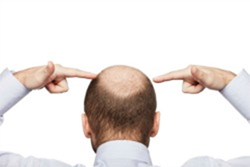 Back view of a man pointing to thinning hair at the crown of his head.