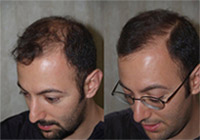 Follicular Unit Micrografting
