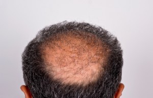 Back view of a man's head showing thinning hair and hair loss at the crown.