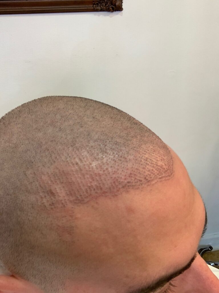Close-up of a shaved scalp showing scalp micropigmentation along the hairline.
