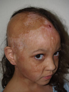 Side view of a young patient before hair restoration showing significant scalp hair loss.