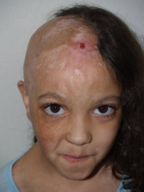 Young patient before hair restoration showing extensive hair loss affecting one side of the scalp.