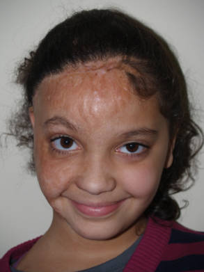 Young patient before hair restoration with visible hair loss across the frontal scalp.