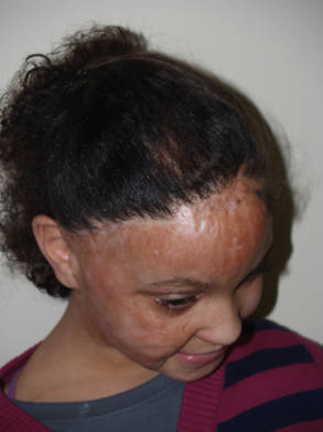 Young patient before hair restoration showing thinning along the front hairline.