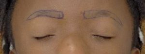 Surgical markings outlining the planned eyebrow shape before an eyebrow restoration procedure.