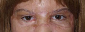 Close-up of the patient's eyes following facial reconstruction and eyebrow restoration treatment.