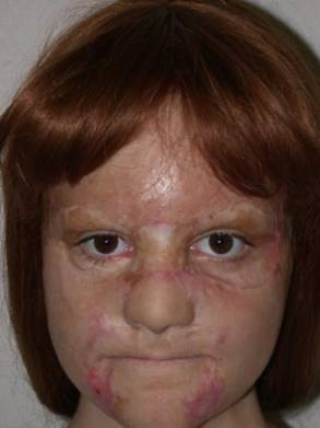 Paciente joven antes de la restauración de cejas, mostrando pérdida de vello en las cejas tras un traumatismo facial.