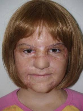 Paciente joven tras una reconstrucción facial y restauración de cejas con una mejora en el aspecto de las mismas.