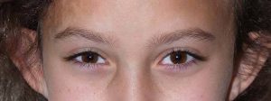 Close-up of the young patient's restored hairline following hair restoration treatment.