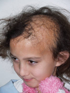 Young patient before hair restoration showing thinning hair across the front of the scalp.